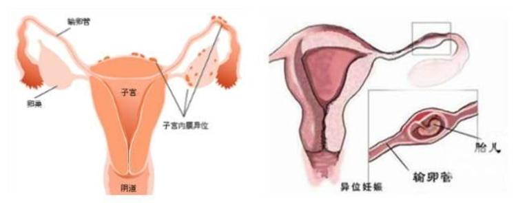 二胎先兆流产